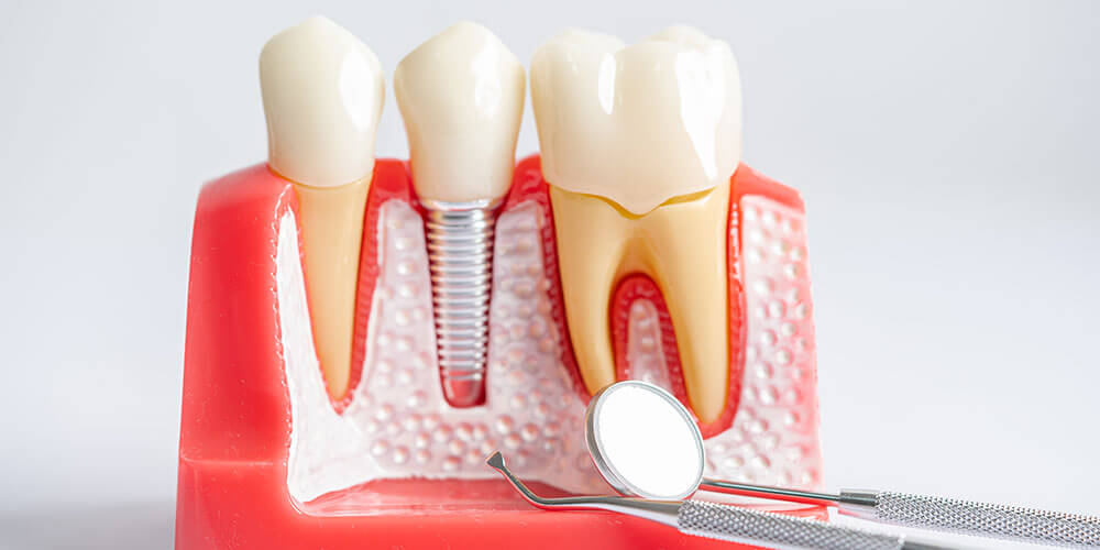 Dental Implants Edmonton